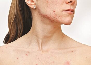 Sarampo alastra em Portugal e Direção-Geral da Saúde (DGS) emite alerta