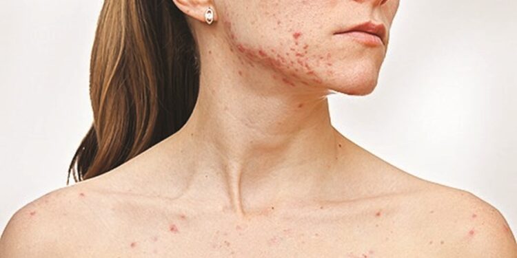 Sarampo alastra em Portugal e Direção-Geral da Saúde (DGS) emite alerta