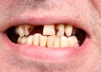 Portugal com a “boca podre”: 60% dos portugueses tem falta de dentes na boca. “Tabaco e falta de higiene bucal” pode ser uma das causas