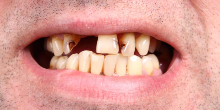 Portugal com a “boca podre”: 60% dos portugueses tem falta de dentes na boca. “Tabaco e falta de higiene bucal” pode ser uma das causas