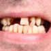 Portugal com a “boca podre”: 60% dos portugueses tem falta de dentes na boca. “Tabaco e falta de higiene bucal” pode ser uma das causas