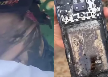 No Ceará mulher de 53 anos sofre queimaduras graves após celular explodir na cintura. “Ficou agarrado na pele”