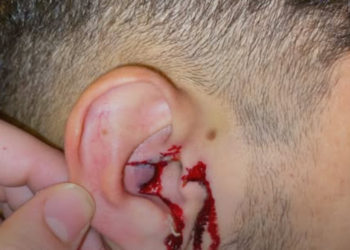 Português embriagado agride brasileiro com soco no ouvido. “Foi parar no hospital e levou 20 pontos”