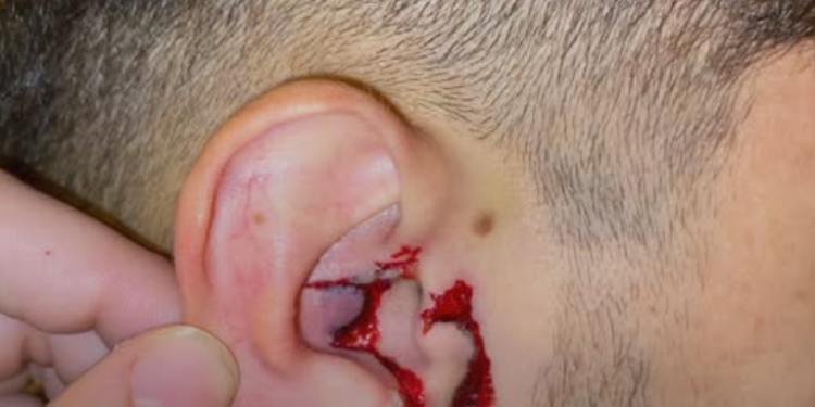 Português embriagado agride brasileiro com soco no ouvido. “Foi parar no hospital e levou 20 pontos”